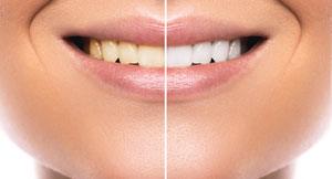 Dents parfaitement blanches avec le blanchiment des dents, aussi appelé blanchiment dentaire : avant et après