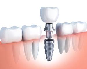 Esthétique des dentes et du sourire : les implants dentaires